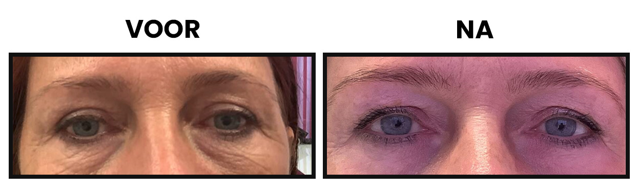 bovenooglidcorrectie bovenooglidcorrectie